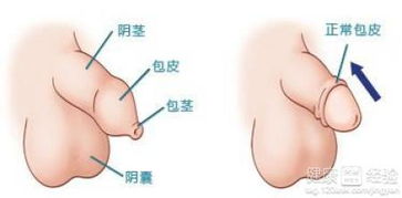 割除包皮的必要性：这样做究竟有哪些益处？