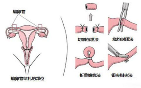 女性复通手术的费用大概是多少？手术价格受哪些因素影响？